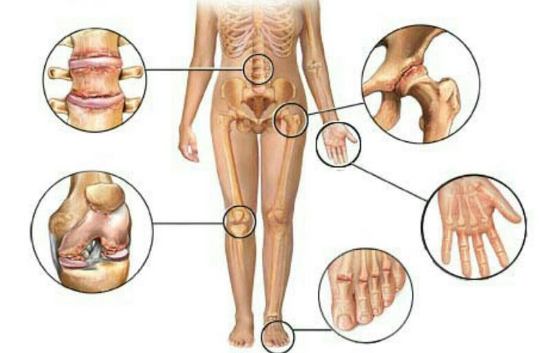 types et degrés d'arthrose