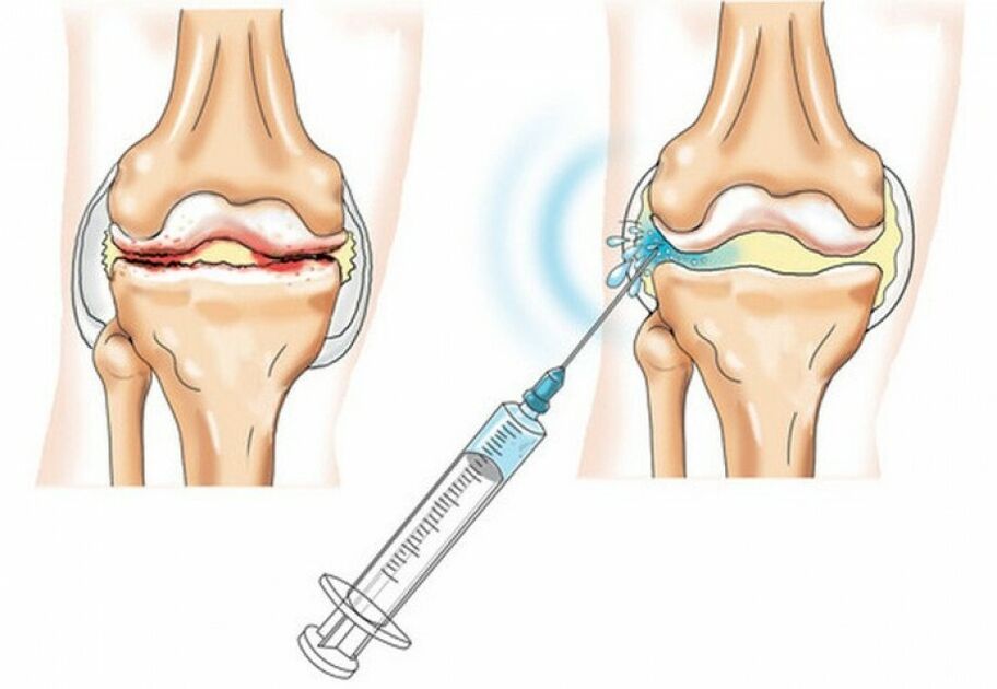 injection dans l'articulation du genou avec arthrose
